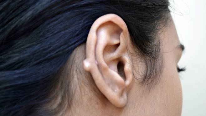 귀를 뚫은 후 멍울이 만져진다면 켈로이드를 의심해 봐야 한다 | 출처: 클립아트코리아