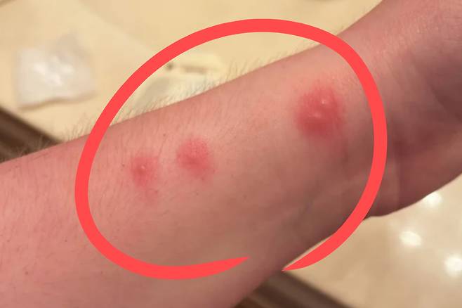 빈대에 물린 자국.[레딧(Reddit) 갈무리]