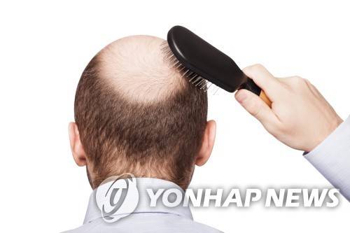 탈모 [서울아산병원 제공]