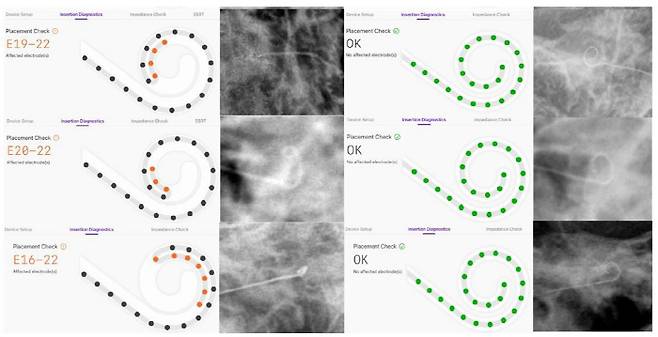 SmartNav가 탐지한 전극 끝말림 확인과 재삽입 후 정상화된 모습, X-ray와 함께 이를 시각적으로 제시했다.
