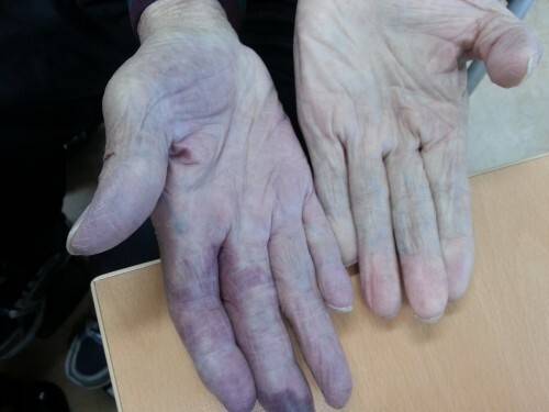레이노증후군 환자의 손. 세계일보 자료사진