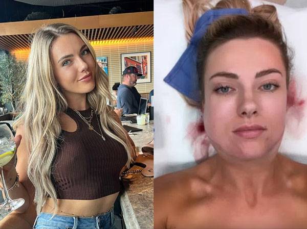 소셜미디어 보정 필터에 익숙해진 나머지 실제 자신의 얼굴을 혐오하게 되고, 존재하지도 않던 이중턱을 없애기 위해 고액의 성형수술까지 받게 된 한 여성의 사연이 전해졌다. 사진은 아스펜의 성형 전, 이중턱 지방 흡입 수술 직후 모습/사진=데일리메일