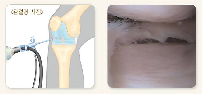 퇴행성 골관절염 환자의 무릎 관절을 관절경으로 관찰하면 연골이 손상된 모습을 볼 수 있다. 국가건강정보포털