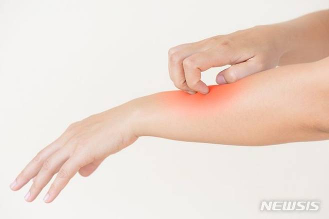 [서울=뉴시스] 피부 발진 이미지(사진=뉴시스 DB) photo@newsis.com *재판매 및 DB 금지