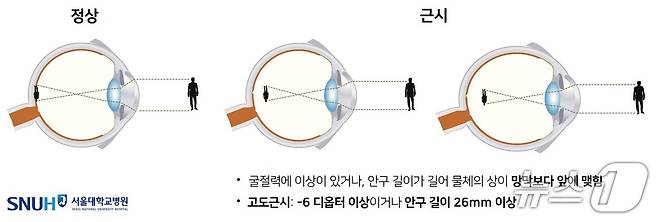 근시는 눈으로 들어온 빛이 망막보다 앞에 맺혀 멀리 있는 물체를 선명하게 보지 못하는 상태다. 사진은 고도 근시의 정의.(서울대병원 제공)