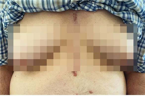 미국의 70대 남성이 고혈압 치료를 위해 약을 복용했다가 가슴이 커지는 부작용을 겪어 화제다./사진=뉴욕포스트