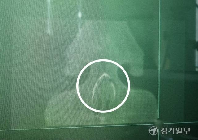 지난 10월21일 평택 B초등학교에서 학교폭력이 발생했다. 사진은 동급생 다툼을 말리다 코뼈가 골절된 피해 학생의 X-ray 사진. 제보자 A씨 제공
