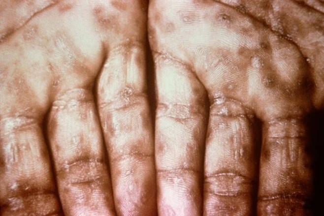 손바닥에 나타난 2차 매독 증상. 미국 질병통제예방센터(CDC) 공중보건이미지라이브러리
