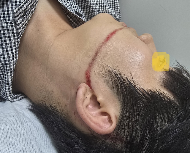 물축제 공연중 워터건에 맞아 얼굴을 크게 다친 피해자. 피해자 측 제공=연합뉴스