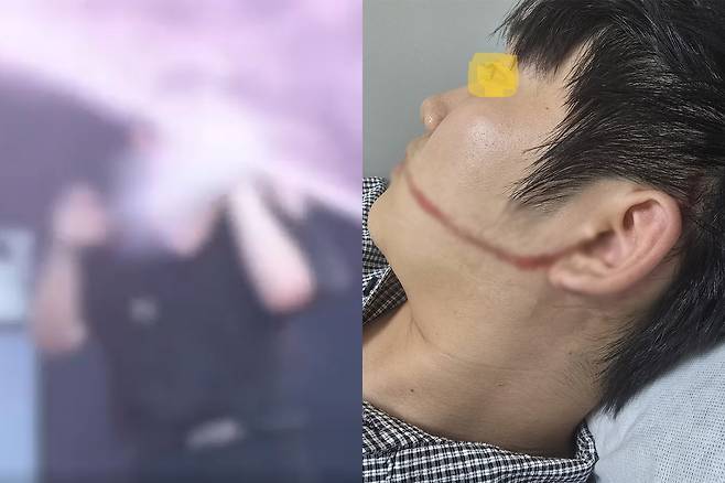 지난해 8월 안산시 물축제에서 공연을 하다 워터건에 부상을 입은 대학생. 연합뉴스