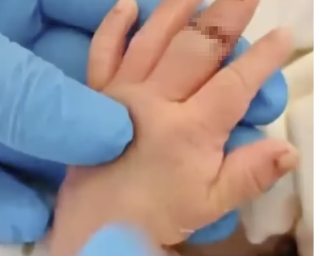 지난달 25일 중국 장쑤성 쉬이현 인민병원에서 제왕절개 수술 도중 신생아의 왼손 중지를 절단하는 사고가 발생했다. 사진은 접합 수술을 받은 신생아의 손 모습. 중국 인터넷 포털 '소후' 캡처
