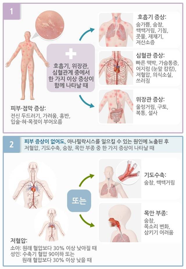아나필락시스 진단 기준. 질병관리청