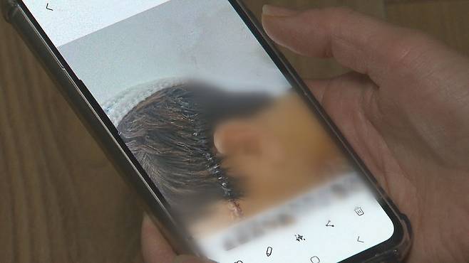 찢어진 얼굴과 두피를 꿰멘 모습