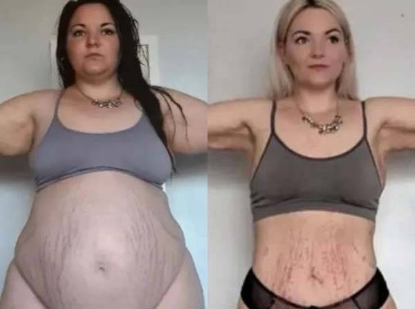 폭식증을 앓던 영국의 한 20대 여성이 2년 만에 45kg 감량에 성공했다. [더 선]