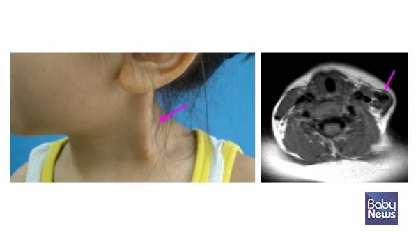 좌측 근성사경과 MRI 소견. ⓒ임신영