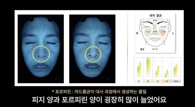 일주일간 고당·고지방 식단 섭취 실험 후 피부 상태. 피친남이승주