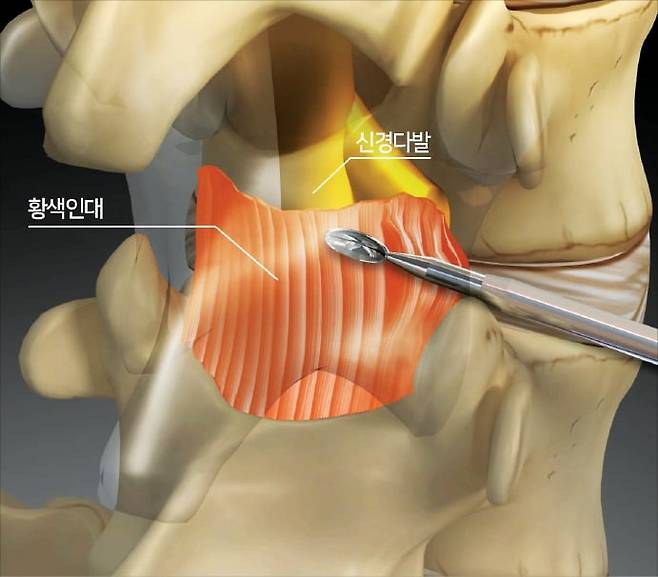 후방 경막외강의 인대를 절제해 디스크에 의한 신경 압박을 완화하는 추간공확장술. /서울 광혜병원 제공