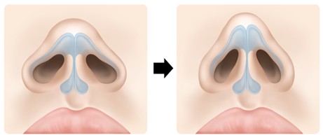 코를 예쁘게 높이려면 피부의 '여유분'이 필요합니다. 사진=슈어스성형외과
