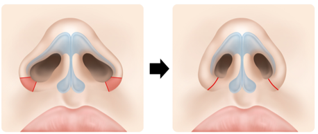 콧볼 축소는 코가 넓어 보인다는 이유로 피부 조직을 잘라내는 수술입니다. 섣불리 콧볼을 줄여버리면, 최적의 코 디자인을 위한 '재료'를 미리 없애버리는 셈입니다. 사진=슈어스성형외과
