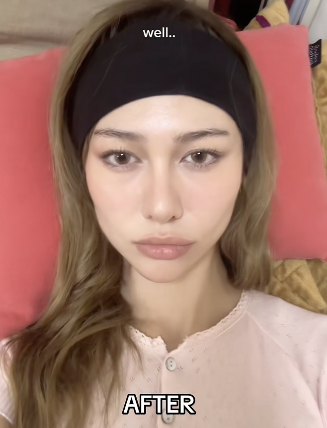 틱톡에서 바이럴 중인 이소티논의 코 미용 효과 ‘accutane nose’. 틱톡 @abigailpalmr