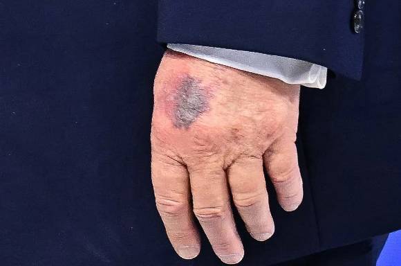 다보스 세계경제포럼(WEF) 연례 회의 중 '평화 위원회(Board of Peace)' 회의에 참석하기 위해 이동하는 도널드 트럼프 미국 대통령의 왼손등에서 멍 자국이 포착되었다. 2026.01.22AFP/연합뉴스 [사진=연합뉴스]