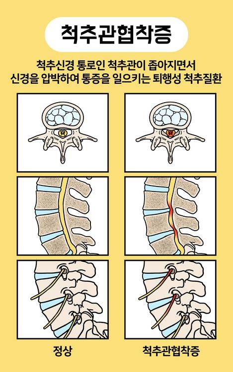 척추관협착증은 노화로 인해 척추 주변 조직이 두꺼워지거나 변형되면서 신경이 지나가는 통로인 척추관이 좁아지는 질환이다. /게티이미지뱅크