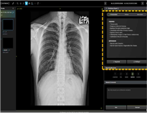 흉부질환 진단보조 생성형 AI 소프트웨어. 식품의약품안전처