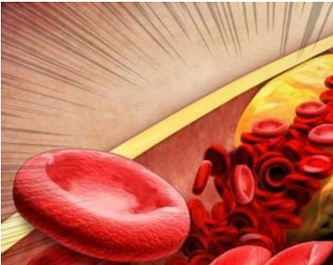 핏속에 쌓인 기름때는 별다른 전조증상 없이 혈관을 막아 심뇌혈관 질환이라는 치명적인 결과를 초래한다. 연합뉴스