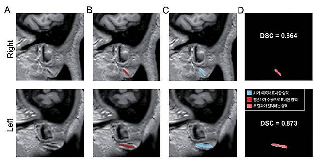 MRI(자기공명영상) 3차원 원본 이미지(A)를 토대로 전문가가 수동으로 직접 표시한 귓불 주름(B)과 AI(인공지능)가 예측해 자동으로 표시한 영역(C). DSC(D)는 두 영역의 겹침 정도를 수치화한 것으로, AI가 전문가와 거의 일치하게(약 87%) 주름을 찾아냈다는 의미다. ⓒ분당서울대병원 제공
