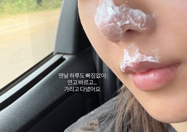 권은비가 코와 입에 2도 화상을 입고 치료를 위해 연고를 발랐다. 권은비 SNS