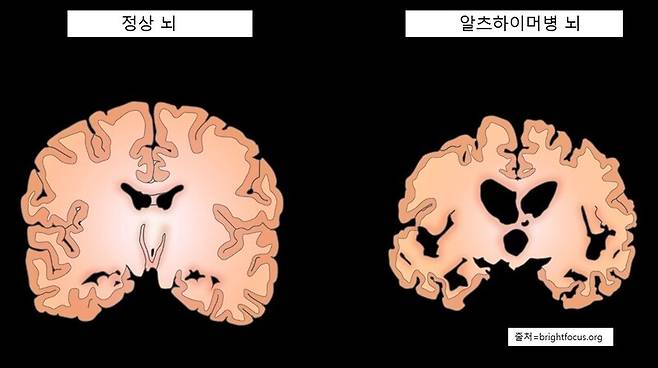 정상 뇌와 알츠하이머병 뇌의 비교.