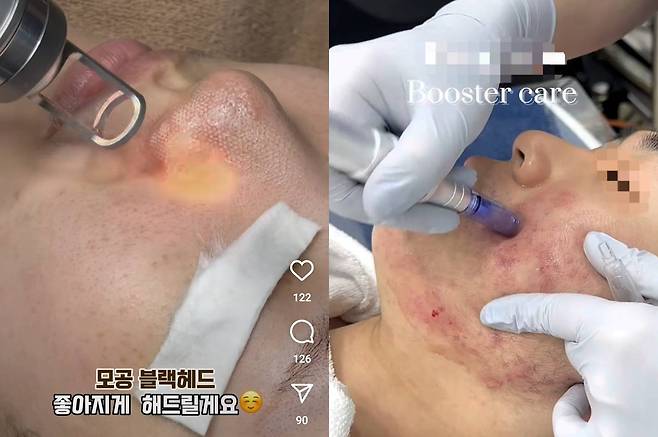 (왼)A 에스테틱 샵의 모공 시술 (오)B 에스테틱 샵의 피부 장벽 개선 시술/사진=SNS 갈무리