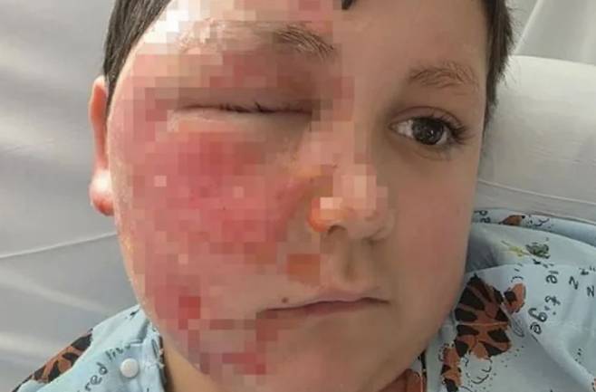 미국 9세 소년이 나도 큐브를 전자레인지에 돌렸다가 화상을 입는 사고가 발생했다. 시카고 선 타임즈