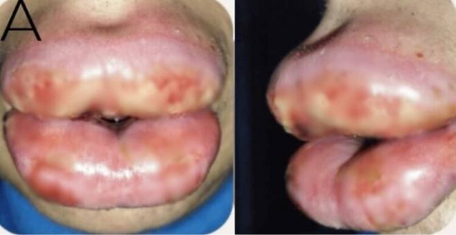 입술 필러 후 부작용이 발생한 사례가 논문에 공개됐다. 사진=큐레우스(Cureus)