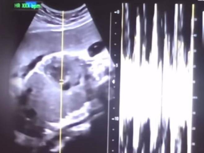 낙태한 산모의 유튜브 동영상에서 캡쳐한 초음파 사진과 심박 그래프. 연합뉴스