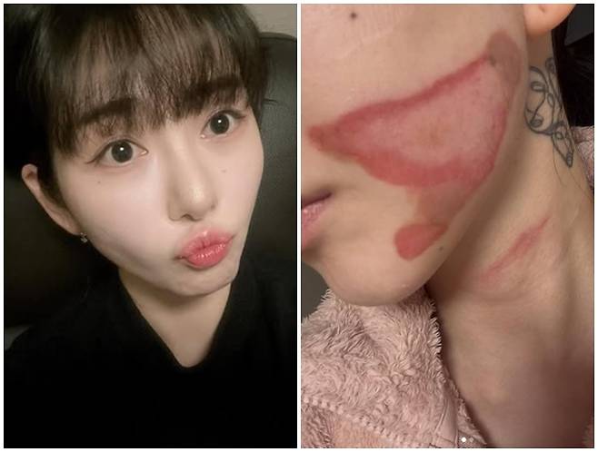 그룹 AOA 출신 권민아가 피부과 시술 후 심각한 화상을 입었다며 당시 상황과 심경을 전했다. / 사진 = 권민아 SNS