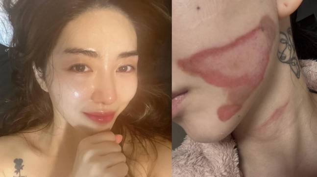 그룹 AOA 출신 권민아가 피부 시술 중 의료사고를 당한 사실을 알렸다. /사진=권민아 인스타그램
