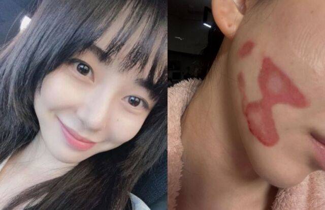 그룹 AOA 출신 권민아가 피부과 시술 중 의료사고를 당했다고 고백했다. / 권민아 소셜미디어