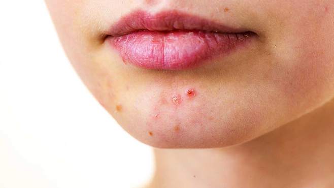 여드름 치료는 염증을 줄이는 것보다 근본적인 문제인 '피지선' 문제를 파악해야 한다｜출처: 클립아트코리아