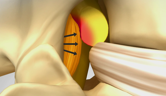 추간공의 전방은 튀어나온 디스크가, 후방은 두꺼워진 황색인대가 신경가지를 누르는 모습.