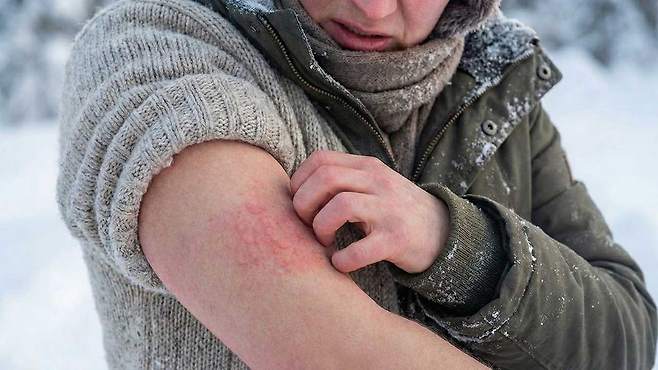 겨울철 야외 활동 중 피부에 화끈거림·붉어짐이 동반된다면, 한랭두드러기를 의심해야 한다｜출처: Gemini 생성