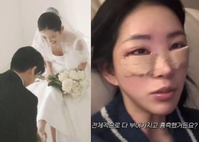 결혼 소식을 알린 최준희가 성형 수술을 받고 회복기를 공개했다. 사진=최준희 인스타그램/유튜브 채널 영상 캡처
