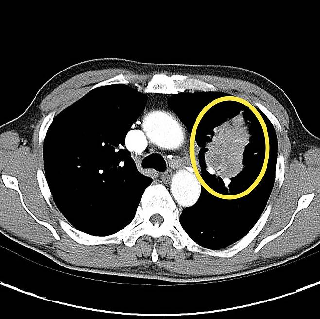 폐암 환자의 CT 검사 사진