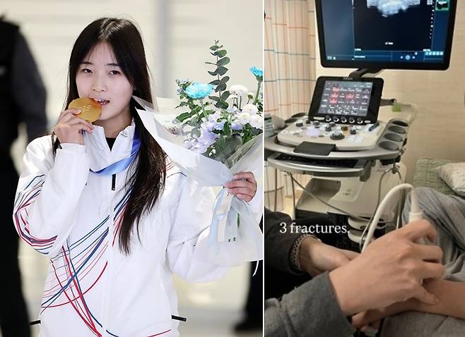 Choi Ga-on, the 2026 Milan-Cortina Olympic snowboarding gold medalist, left, uploads an Instagram post with the caption ″3 fractures″ on Feb. 19. [YONHAP, SCREEN CAPTURE]