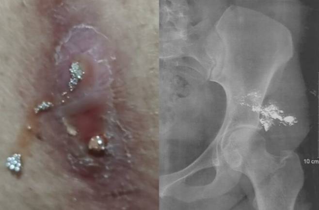 여성 엉덩이 통증을 느낀 부위에서 흘러나온 은색 액체(왼쪽 사진)가 수은으로 밝혀졌다. 오른쪽 사진에서는 여성의 엉덩이에 축적돼 있는 수은이 선명하게 보인다. 사진=클리니컬 케이스 리포트