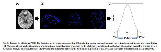 ▲PSMD 산출 과정. 뇌 확산텐서영상(DTI)에서 주요 백질 신경섬유만 추출한 뒤, 확산도 분포의 상위 95%와 하위 5% 값의 차이를 계산해 PSMD를 산출한다. PSMD 값이 클수록 뇌 백질의 미세구조 손상이 큰 것으로 해석된다. 해운대백병원 제공