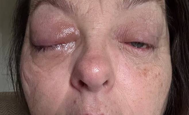 눈에 맥락막 흑색종이 발생한 영국 50대 여성. 사진=데일리메일