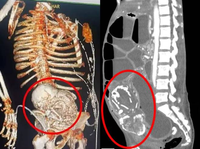 BBC 드라마가 ‘리토페디온’이라는 희귀질환을 다루며 시청자들의 이목을 끌었다./사진=데일리메일