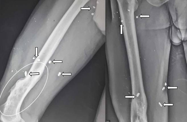 남성의 고관절과 대퇴부에 보이는 금속 파편들. 사진=외과 증례 보고(Surgery Case Reports)