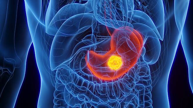 위암은 한국인을 괴롭히는 대표적인 암이다. 신규 위암 환자는 연간 2만9000명에 달한다. 사진=클립아트코리아